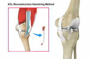   ACL Reconstruction Procedure – Hamstring Tendon  