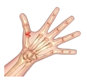  Arthritis of the Thumb  