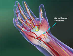   Carpal Tunnel Syndrome  