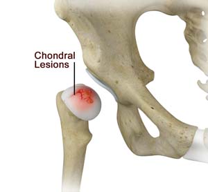 Chondral Lesions  