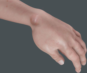   Ganglion Cysts of the Wrist and Hand  