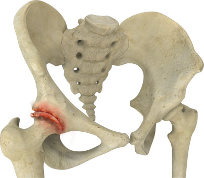 Hip Arthritis  