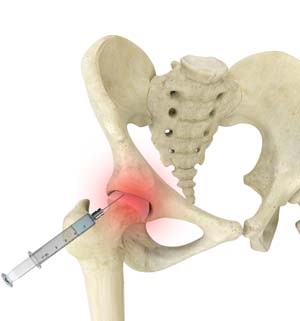   Hip Injections 