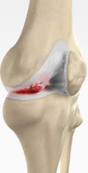 Knee Arthritis  