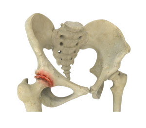  Osteoarthritis of the Hip  