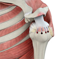  Rotator Cuff Tear 