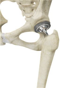  Total Hip Replacement  