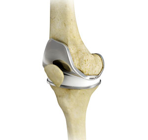 Total Knee Replacement   